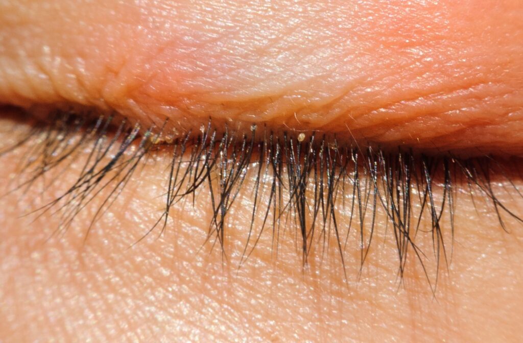 Close up of an eyelid that has blepharitis