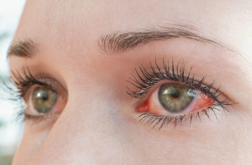 A close up of red, irritated eyes.